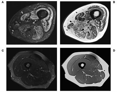 Novel Muscle Imaging in Inflammatory Rheumatic Diseases—A Focus on Ultrasound Shear Wave Elastography and Quantitative MRI